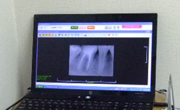 機能性と審美性に優れた入れ歯